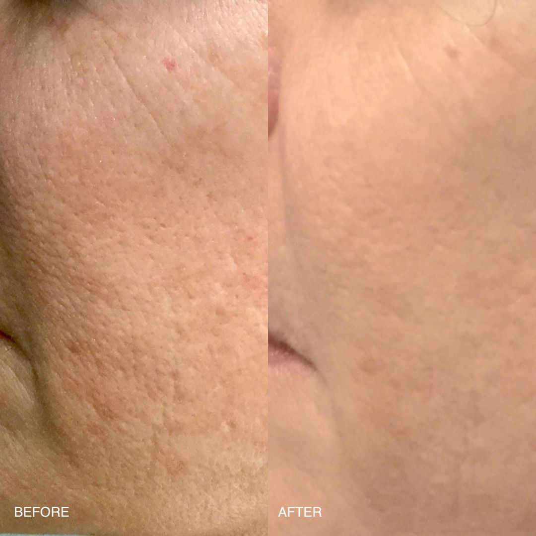 MACRENE actives Face Serum Before and After