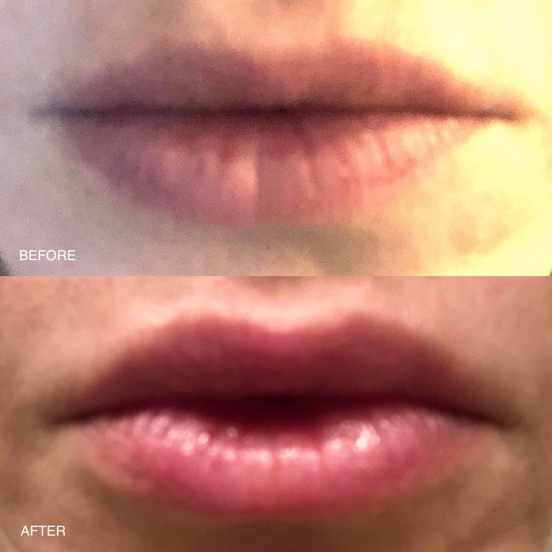 High Performance Lip Filler